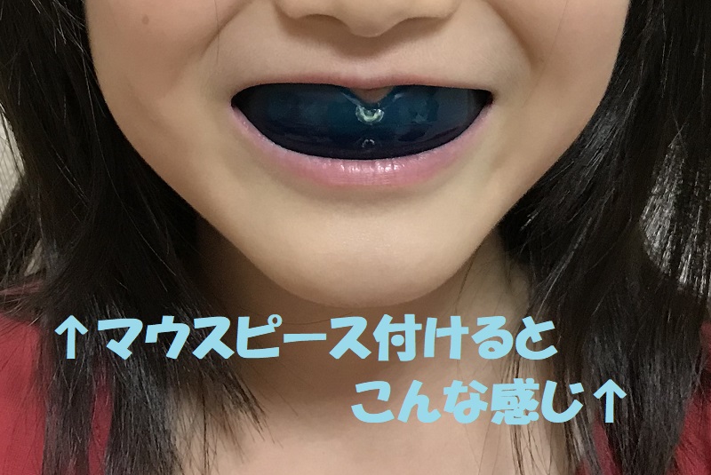子どもの歯の悩み 反対咬合の矯正 ママライフを たのしく かしこく Mamaco With